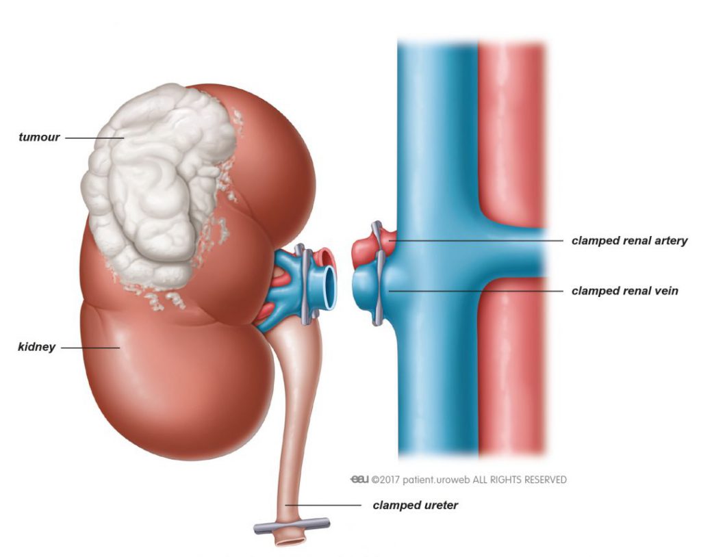 Radical nephrectomy