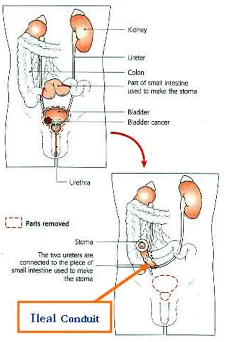 Bladder Cancer