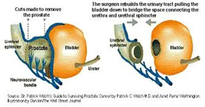 Prostate Cancer