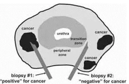 Prostate Cancer