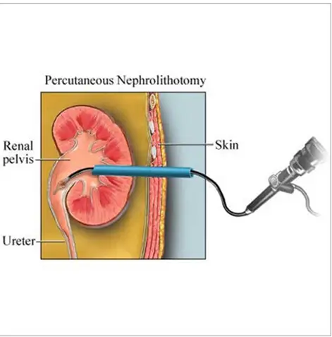 Kidney Stone Treatment In Pune
