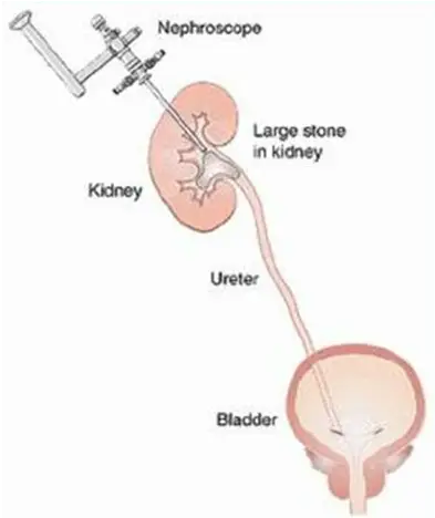 kidney stone removal in Pune