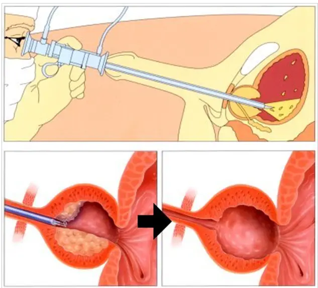 Minimally invasive BPH treatment