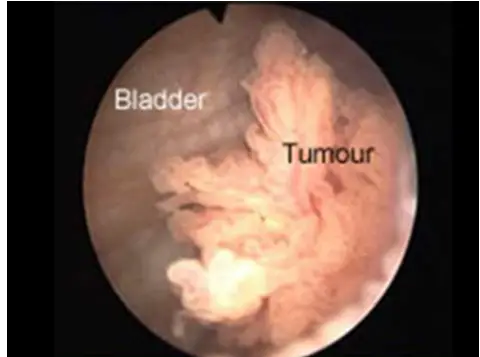 Bladder Cancer