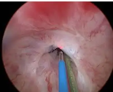 endoscopic