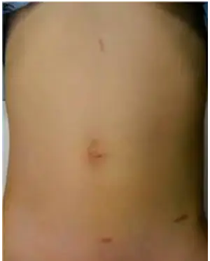 Pelviureteric junction obstruction